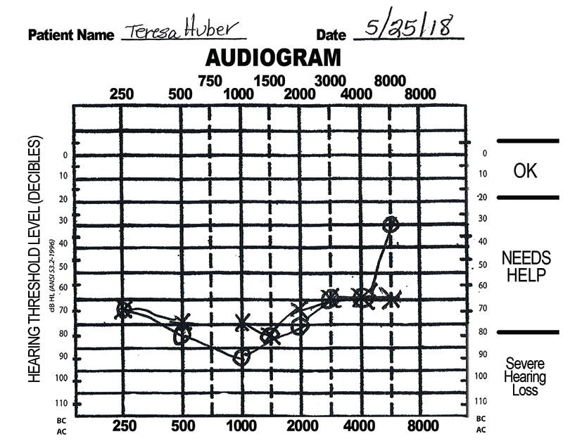 audiogram of a person with hearing loss